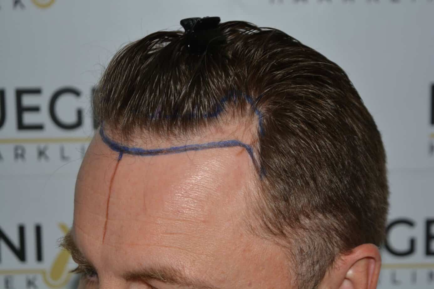 Come And See A Perfect Blond Hairline