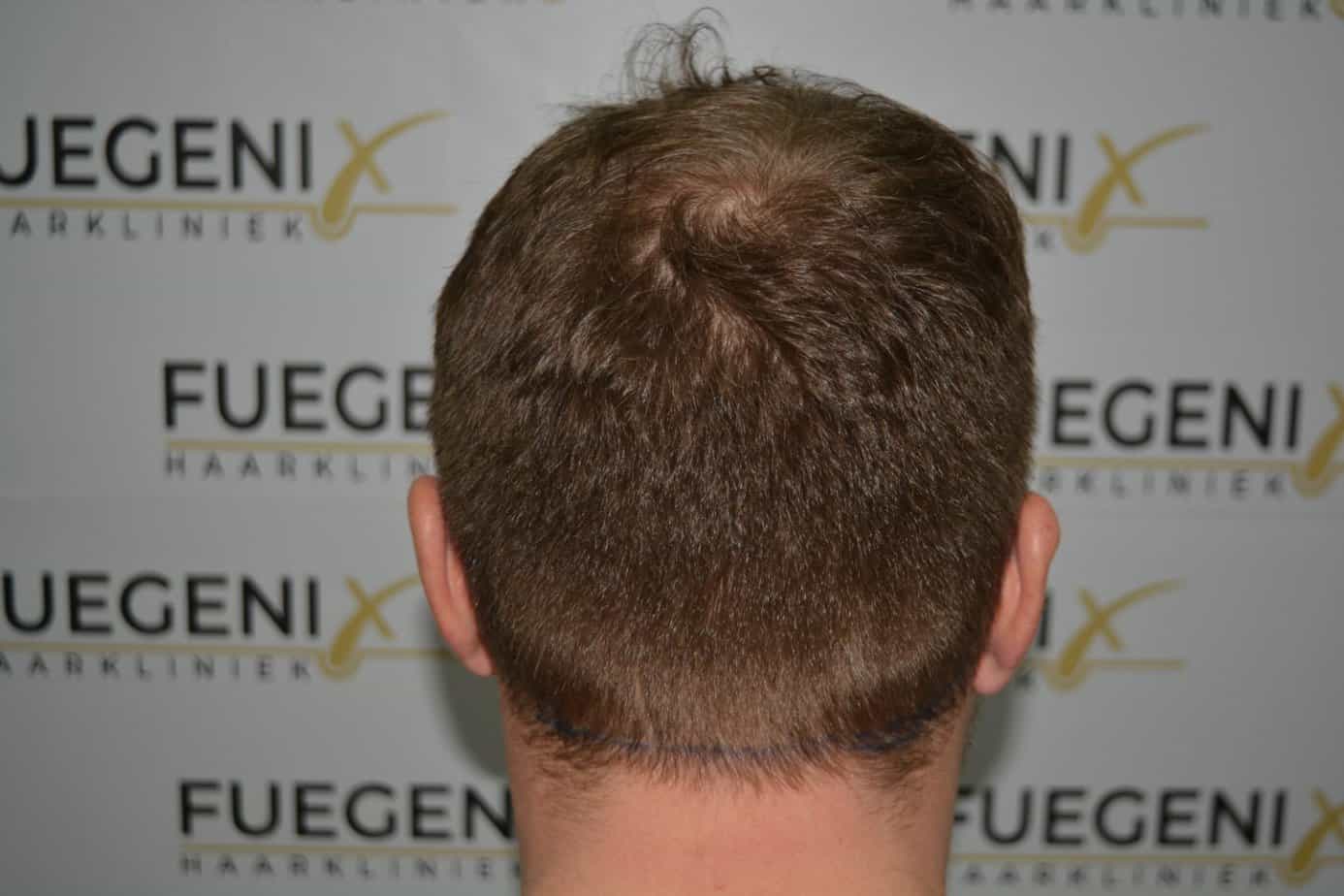 Come And See A Perfect Blond Hairline