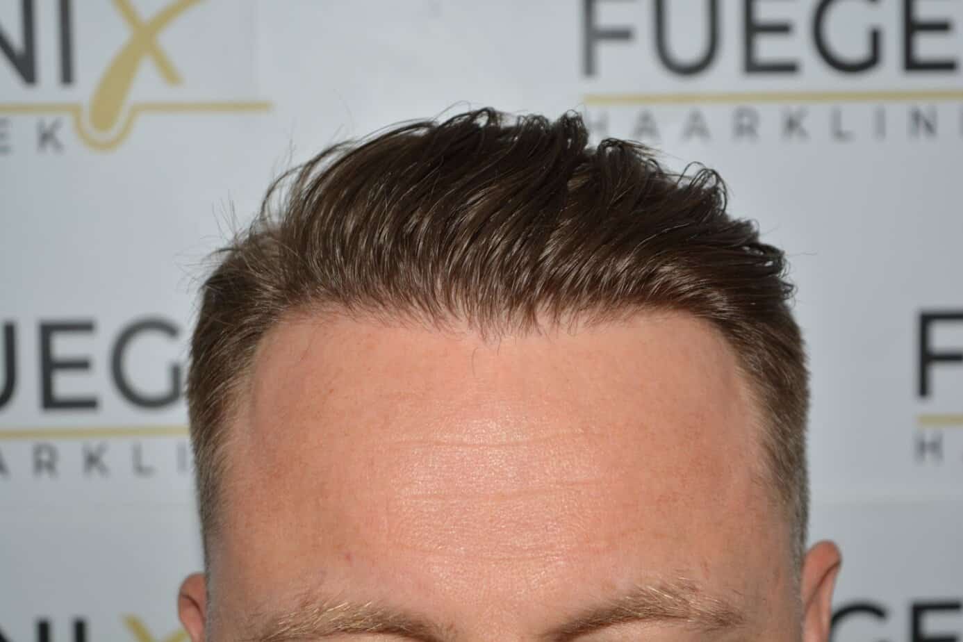 Come And See A Perfect Blond Hairline