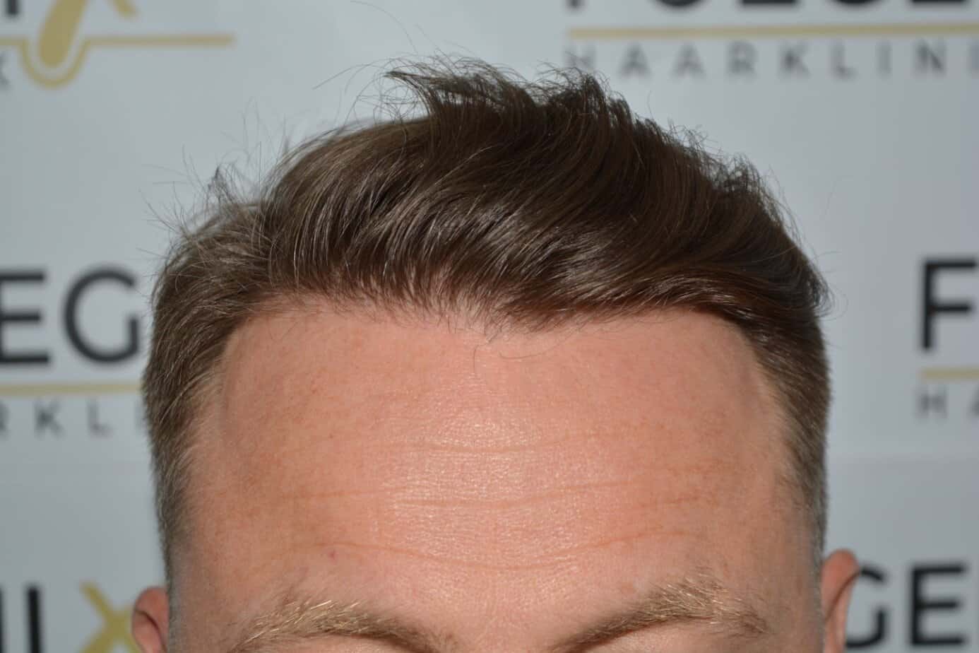Come And See A Perfect Blond Hairline