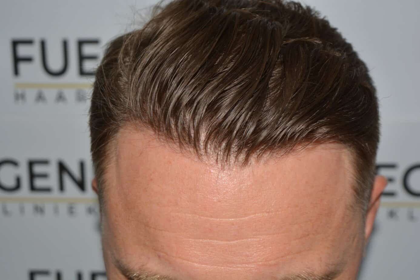Come And See A Perfect Blond Hairline