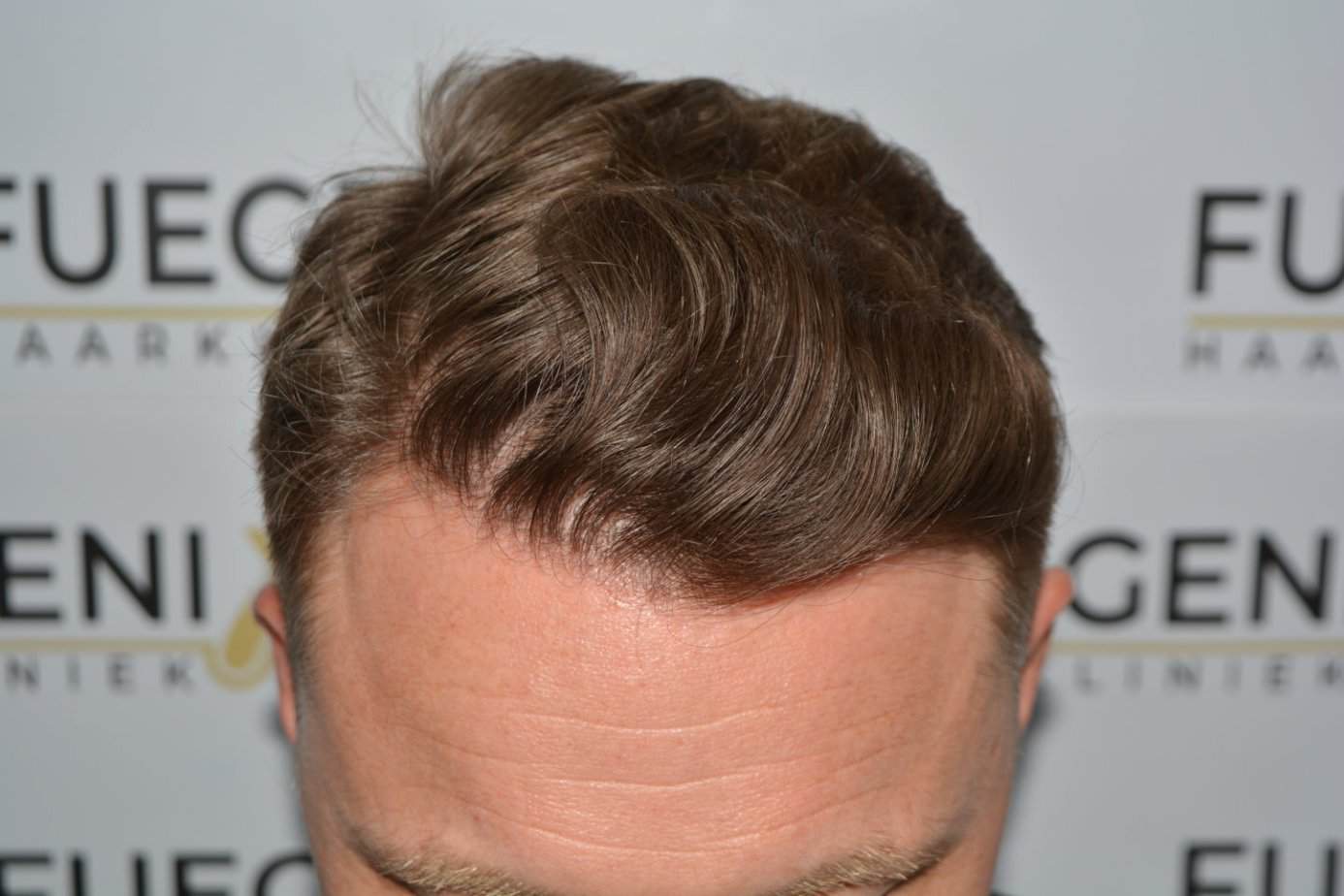 Come And See A Perfect Blond Hairline