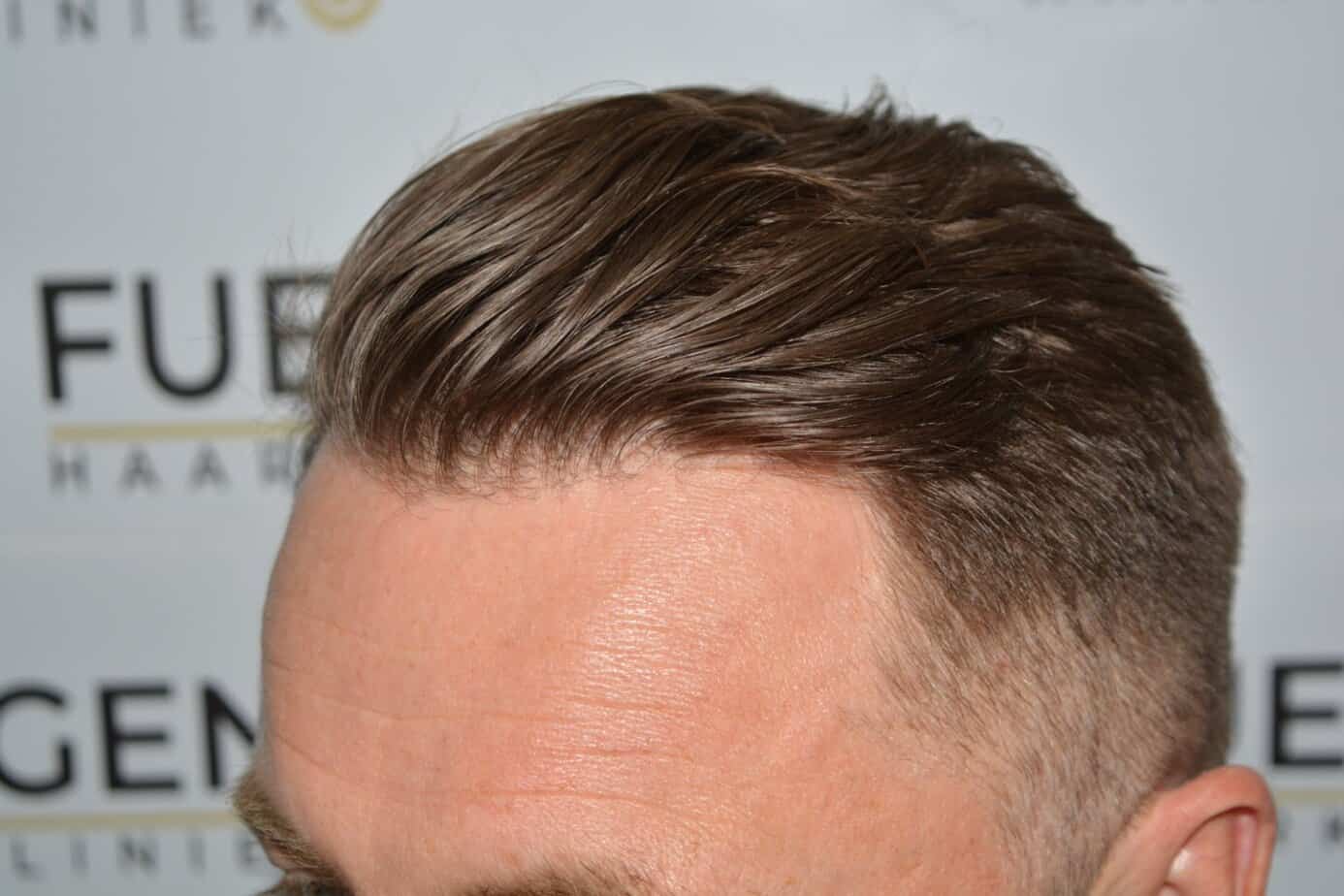 Come And See A Perfect Blond Hairline