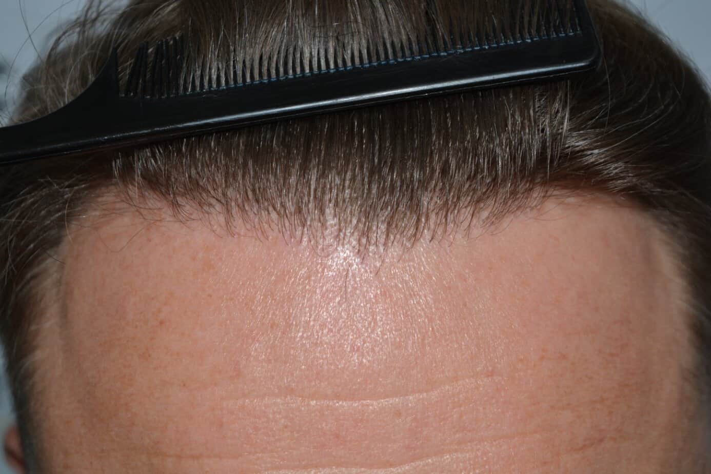 Come And See A Perfect Blond Hairline
