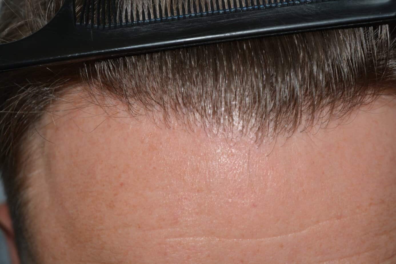 Come And See A Perfect Blond Hairline