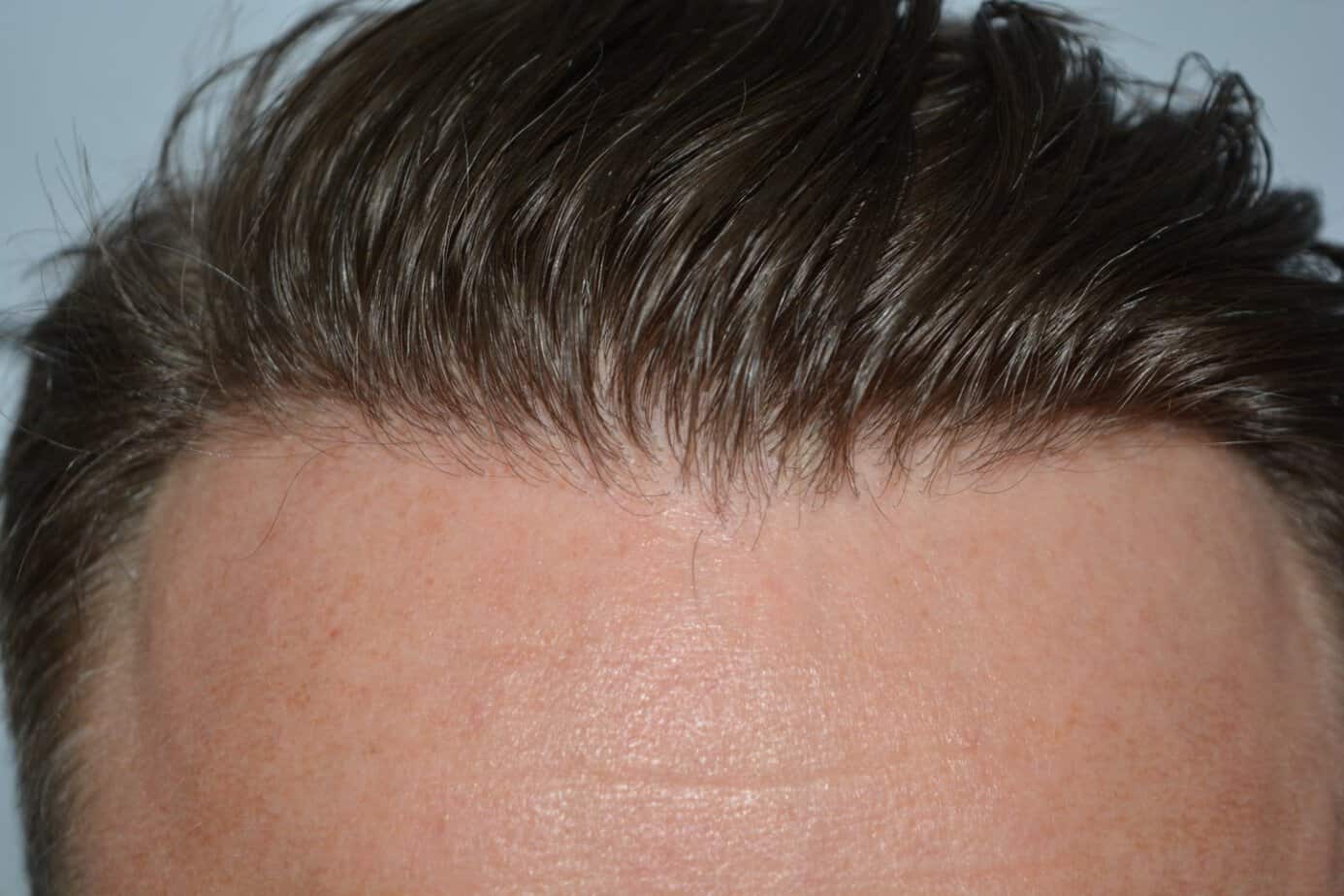 Come And See A Perfect Blond Hairline