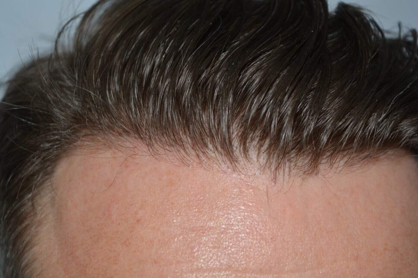 Come And See A Perfect Blond Hairline