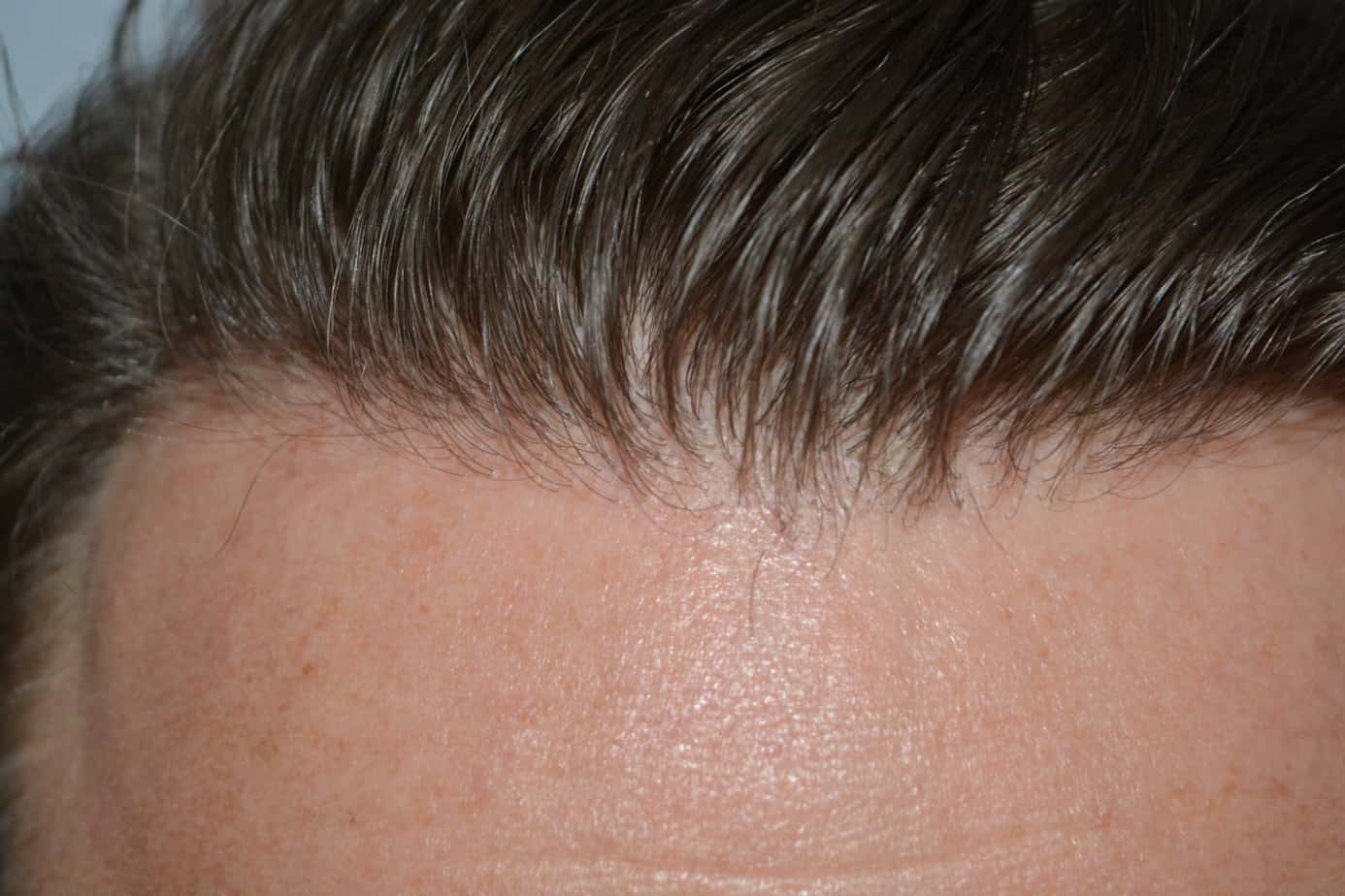 Come And See A Perfect Blond Hairline