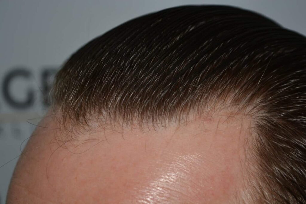 Come And See A Perfect Blond Hairline