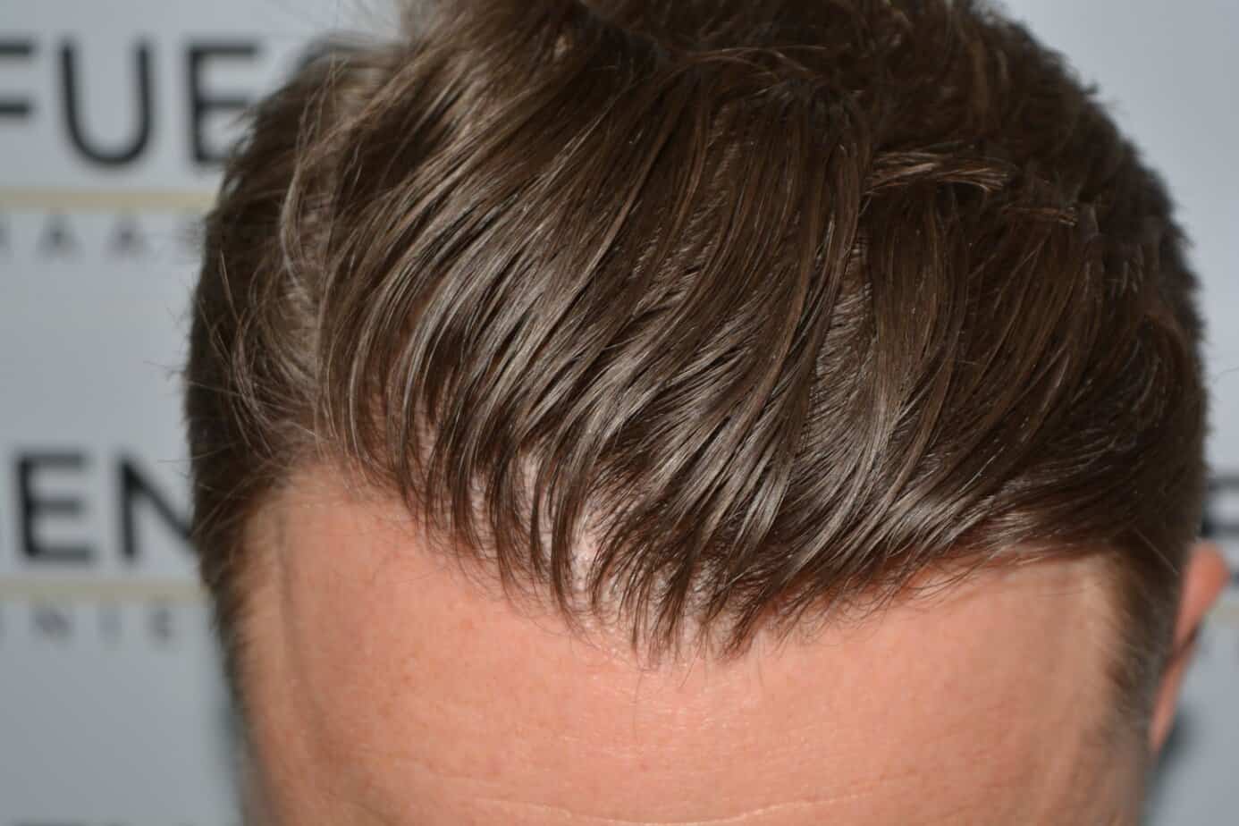 Come And See A Perfect Blond Hairline