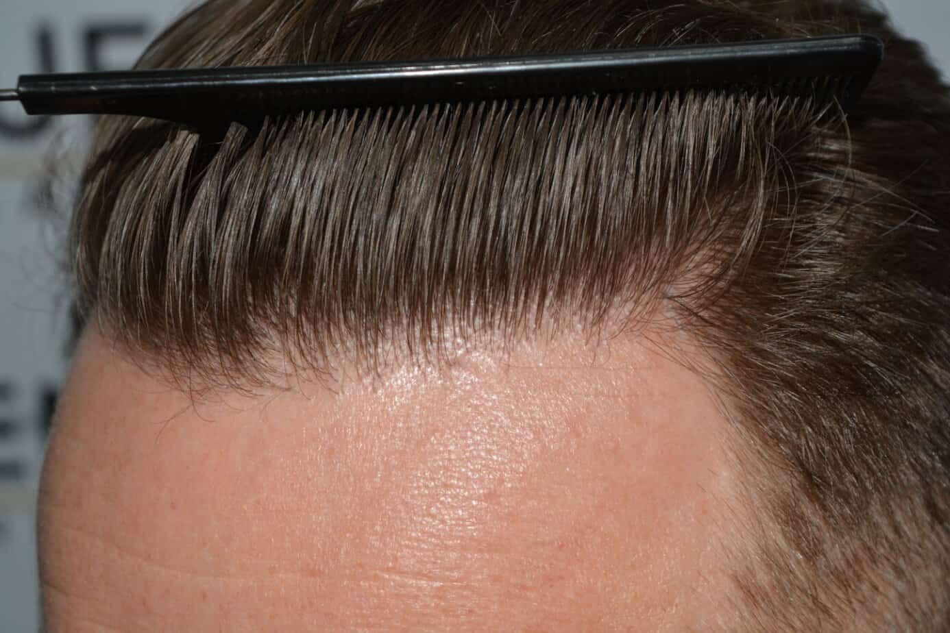 Come And See A Perfect Blond Hairline