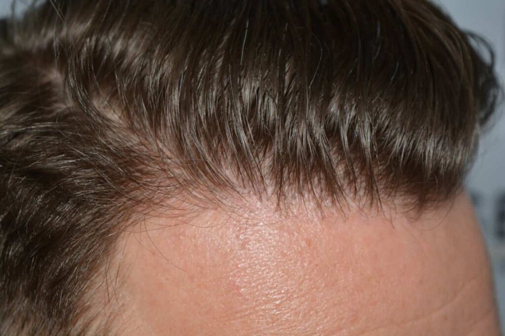 Come And See A Perfect Blond Hairline