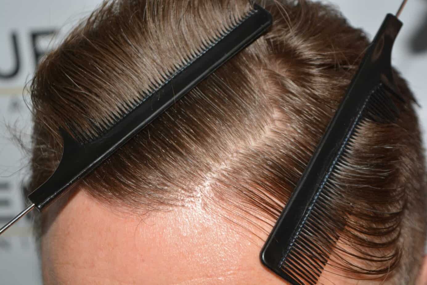 Come And See A Perfect Blond Hairline