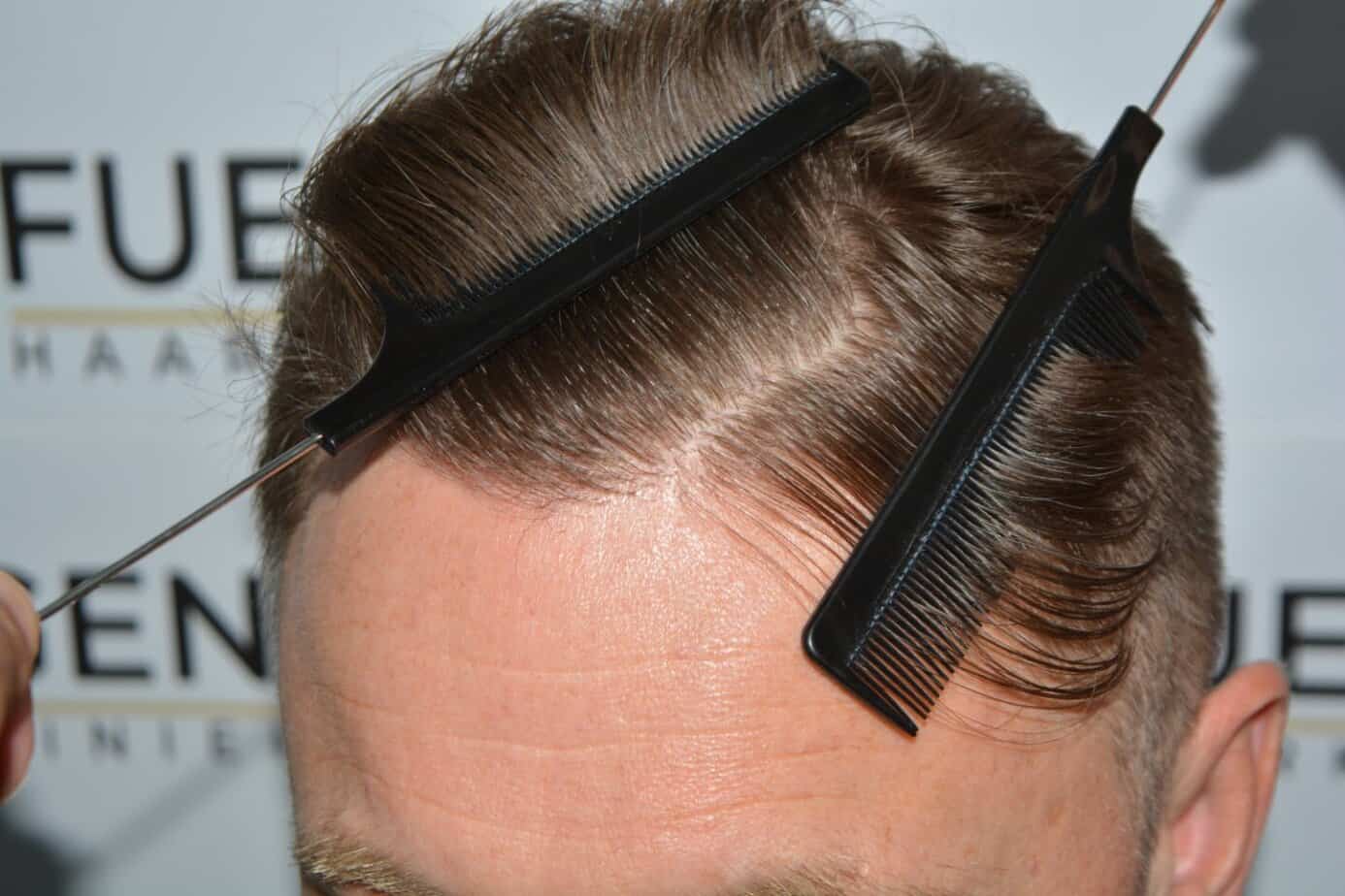Come And See A Perfect Blond Hairline