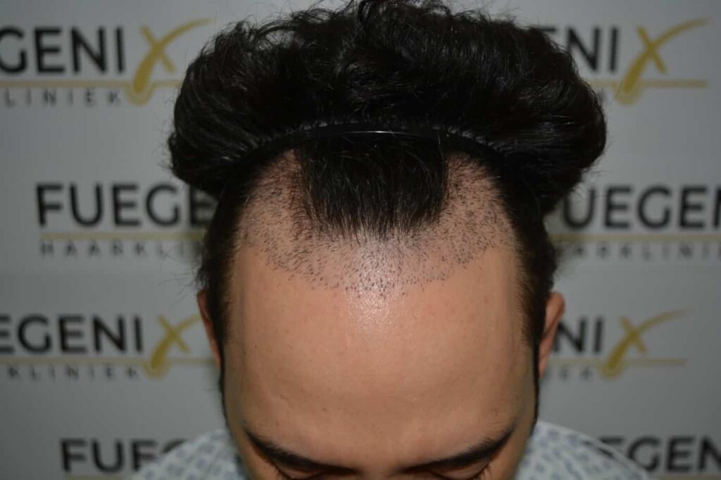 One Surgery Repair