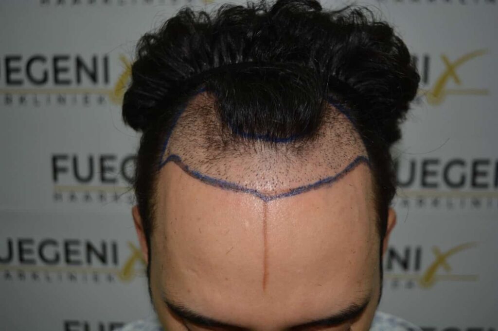 One Surgery Repair