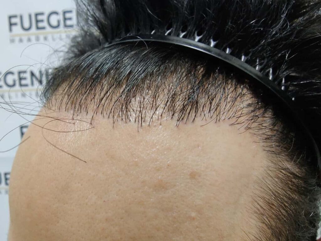 One Surgery Repair