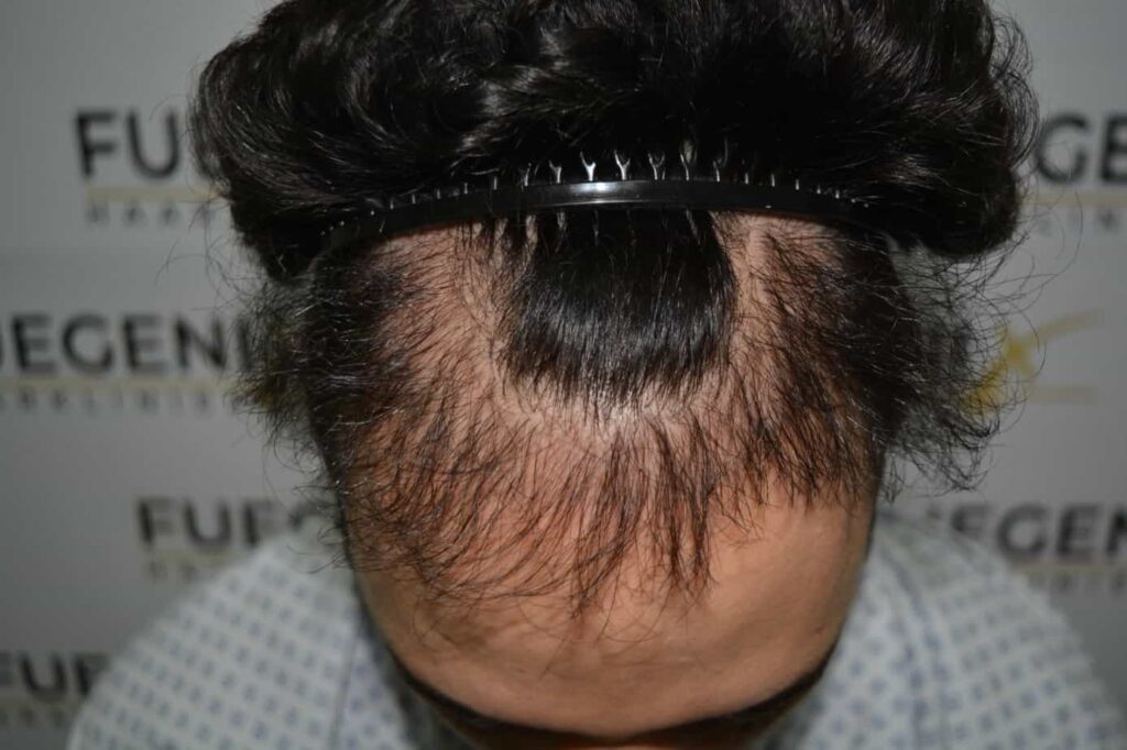 One Surgery Repair