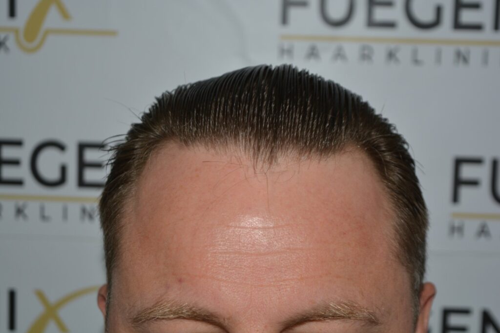 Hairline 18 Months Post Op Result