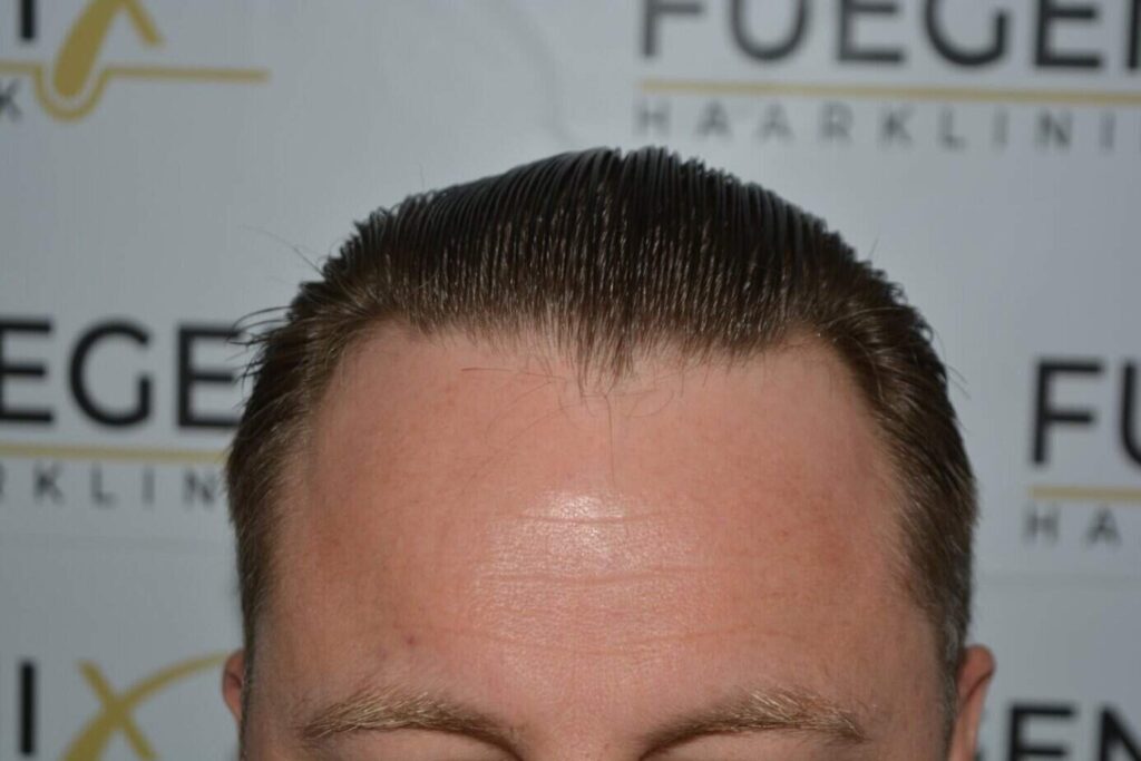 A Perfect Blond Hairline