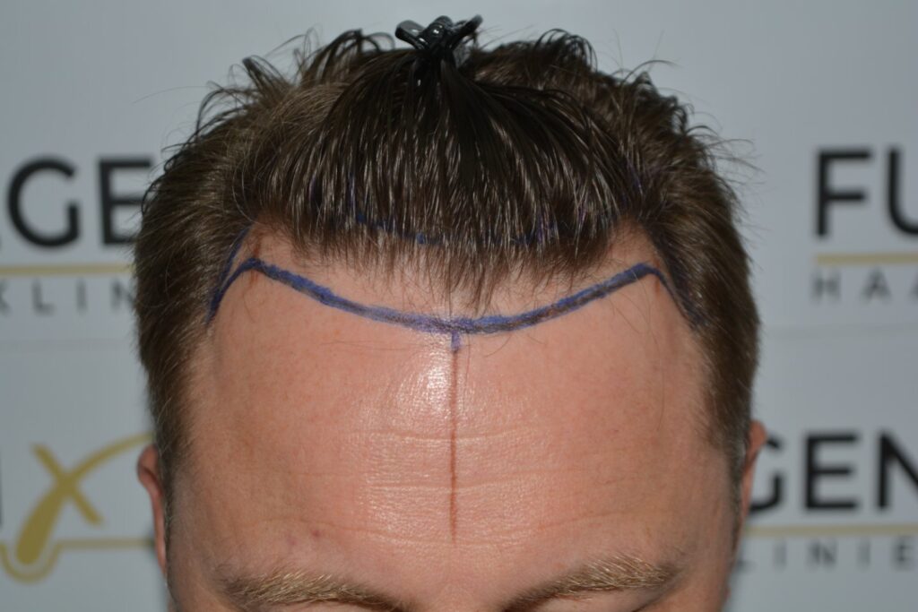 Hairline 18 Months Post Op Result