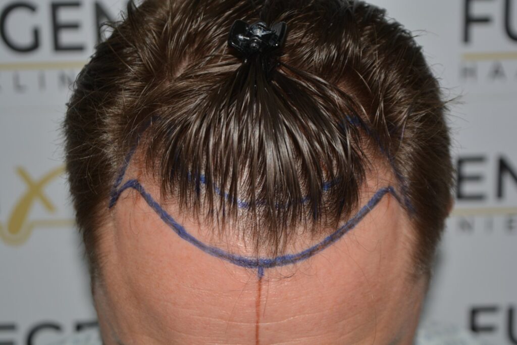 Hairline 18 Months Post Op Result