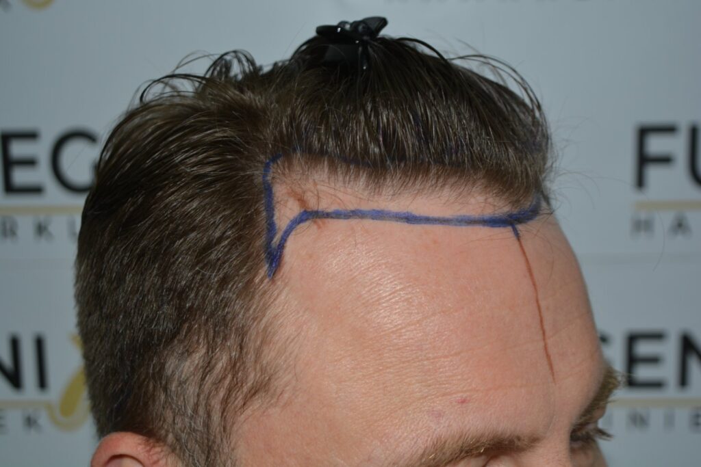 Hairline 18 Months Post Op Result