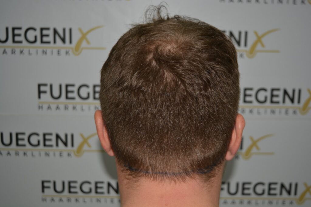 Hairline 18 Months Post Op Result
