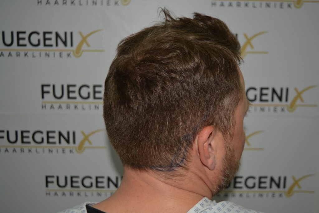 Hairline 18 Months Post Op Result