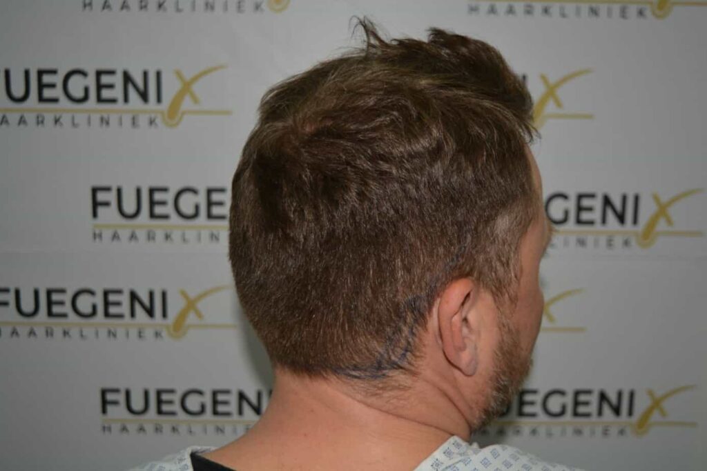 A Perfect Blond Hairline