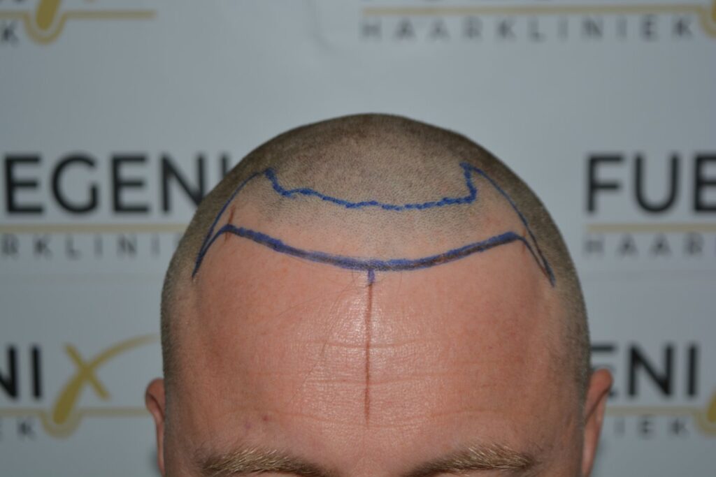 Hairline 18 Months Post Op Result