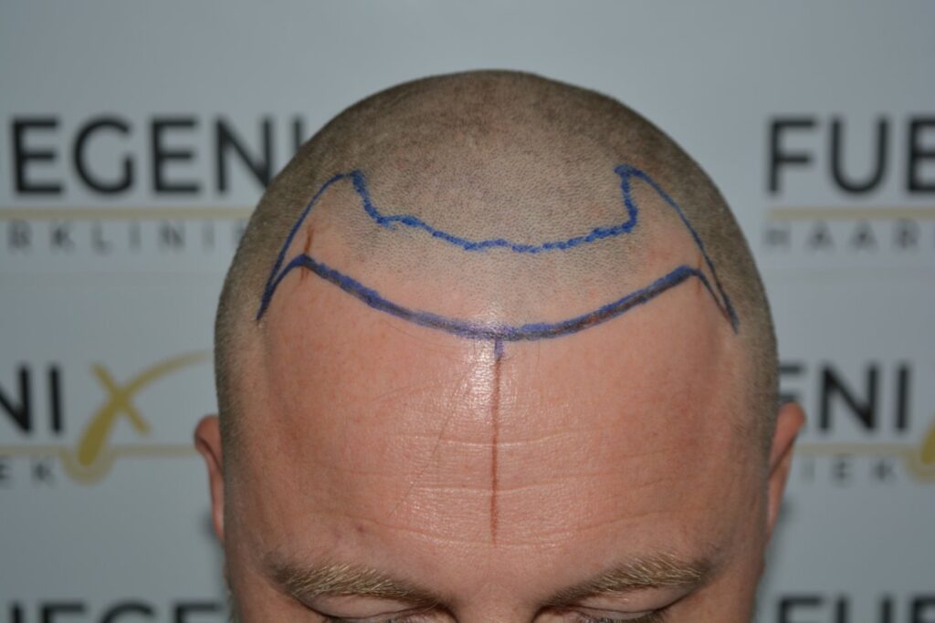 Hairline 18 Months Post Op Result