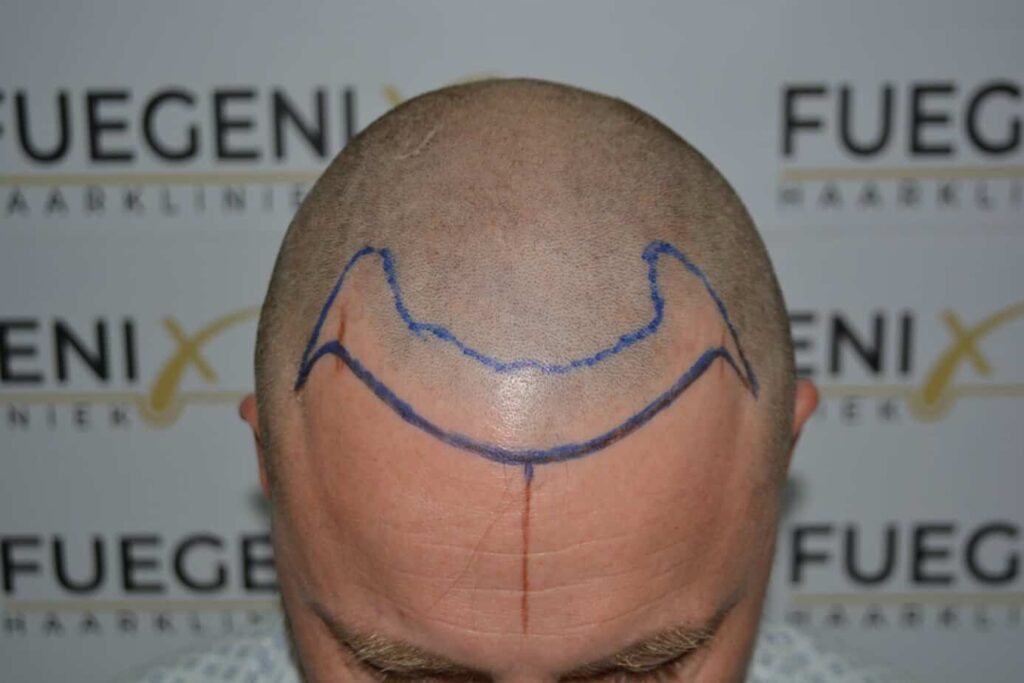 A Perfect Blond Hairline