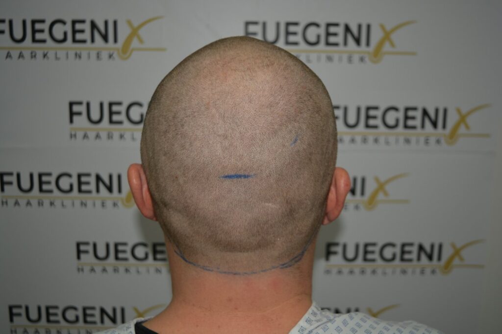 Hairline 18 Months Post Op Result