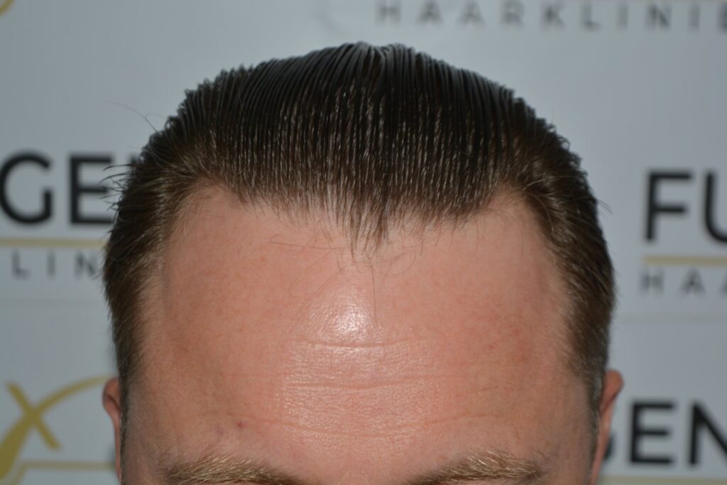 Hairline 18 Months Post Op Result