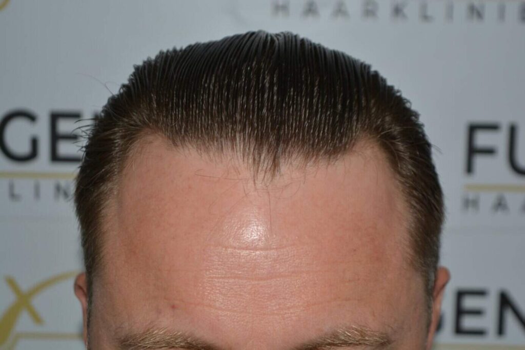 A Perfect Blond Hairline
