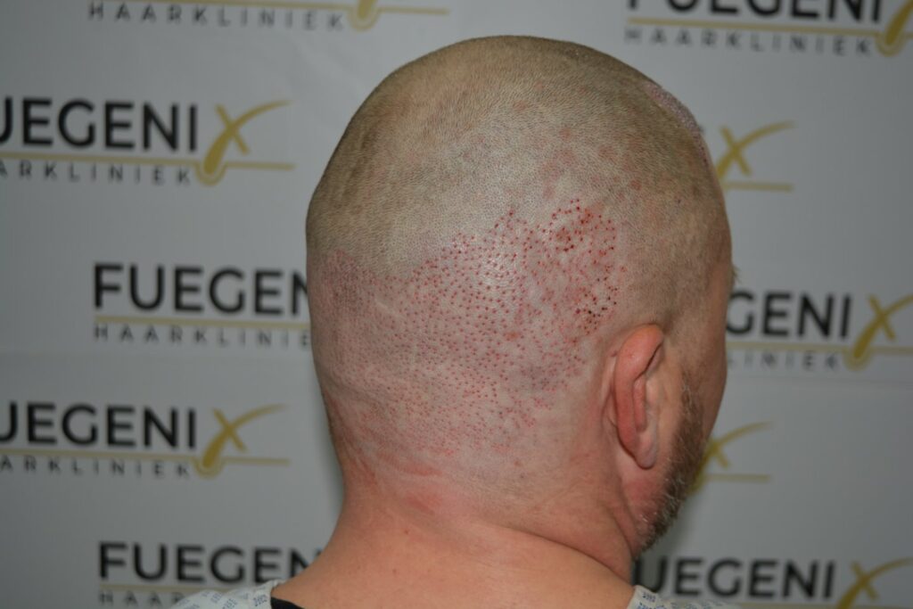 Hairline 18 Months Post Op Result