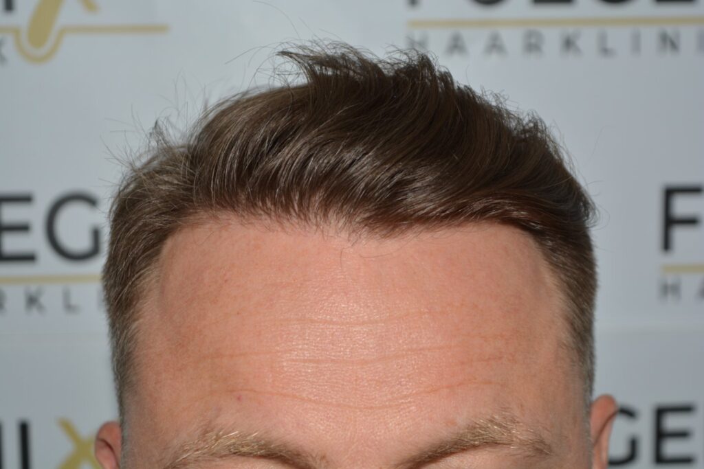 Hairline 18 Months Post Op Result