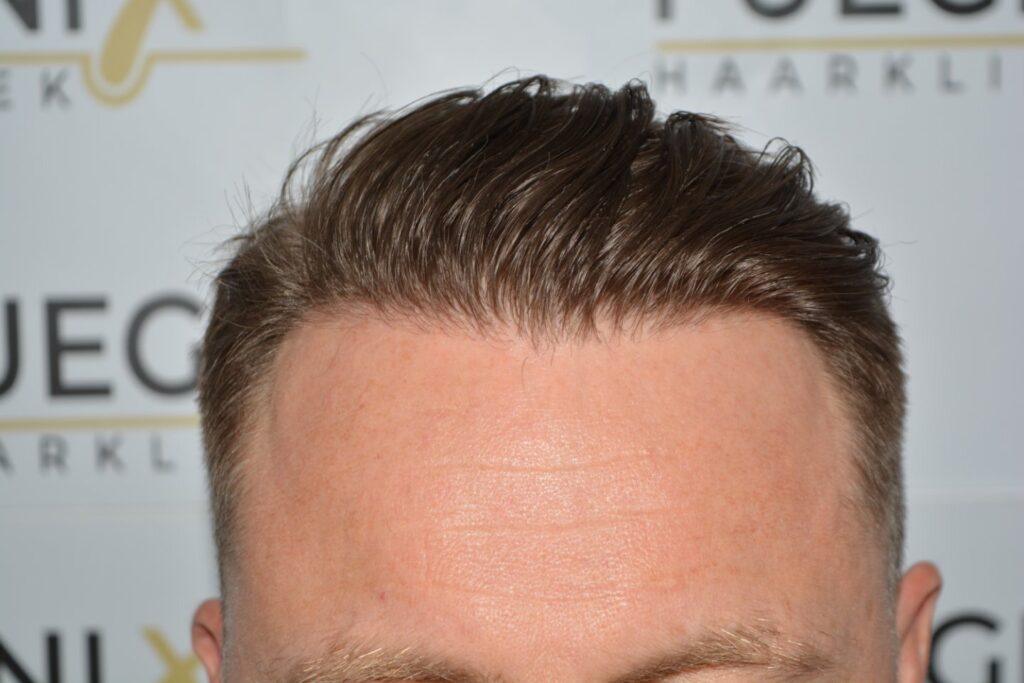 Hairline 18 Months Post Op Result