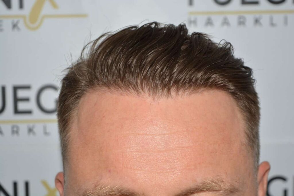 A Perfect Blond Hairline