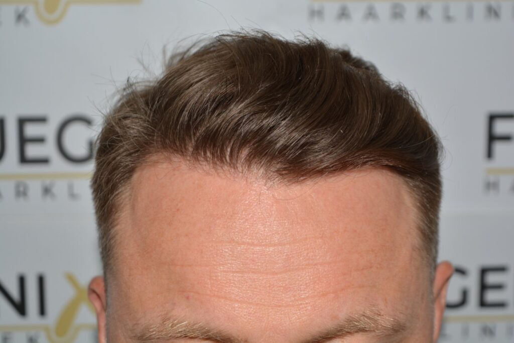 Hairline 18 Months Post Op Result