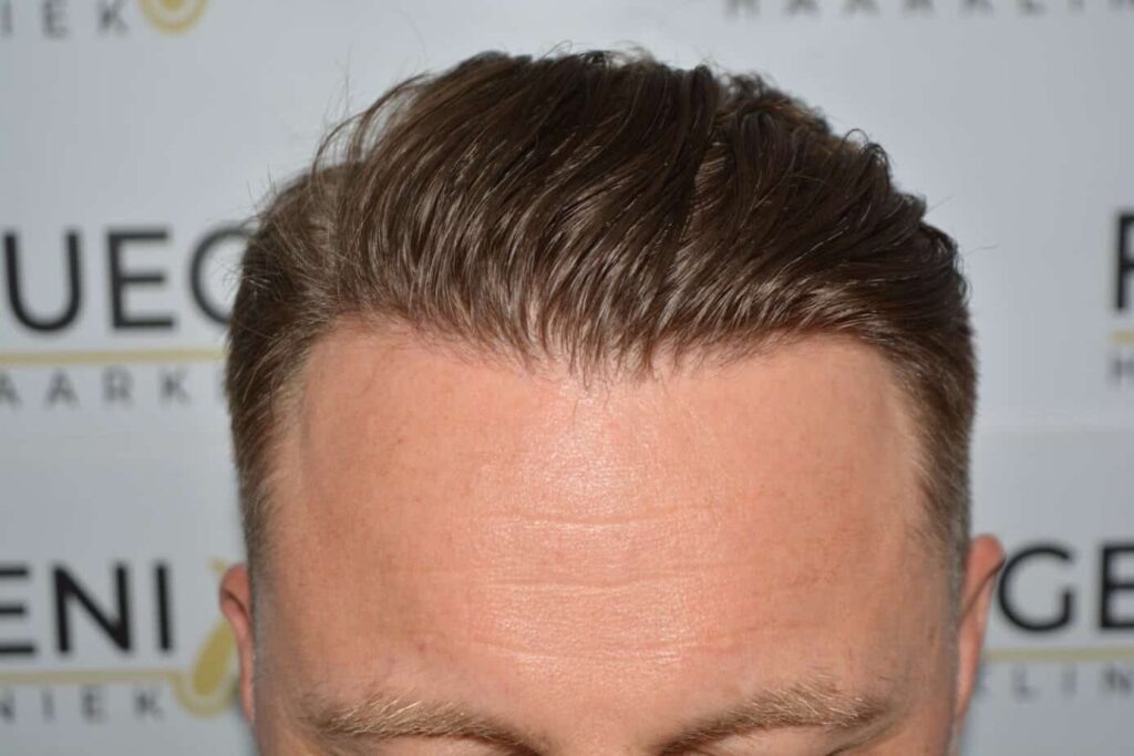 A Perfect Blond Hairline