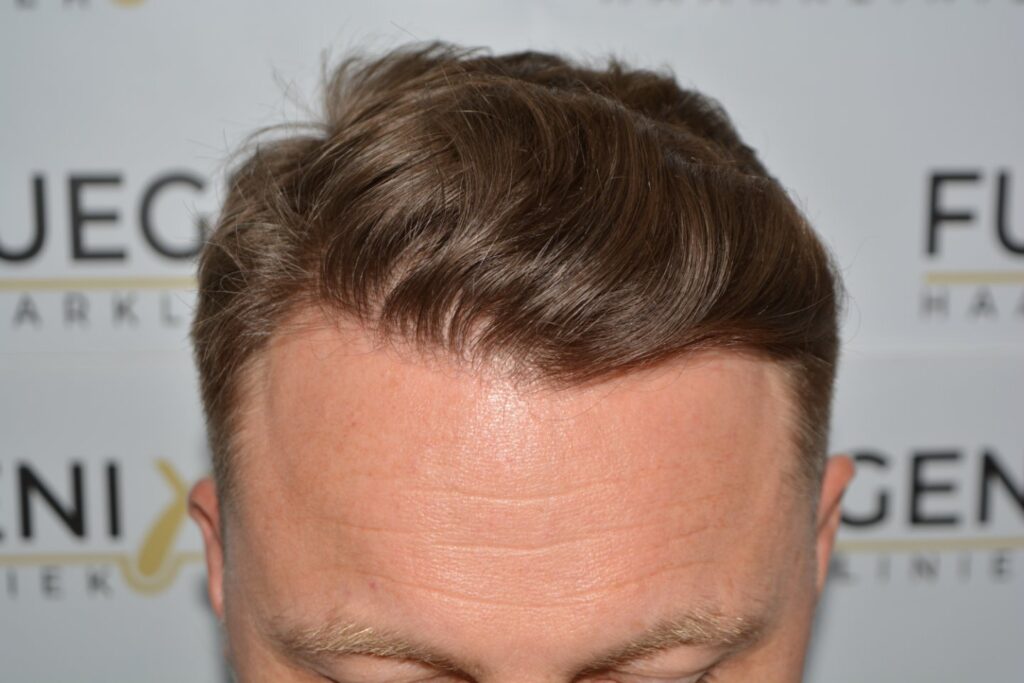 Hairline 18 Months Post Op Result