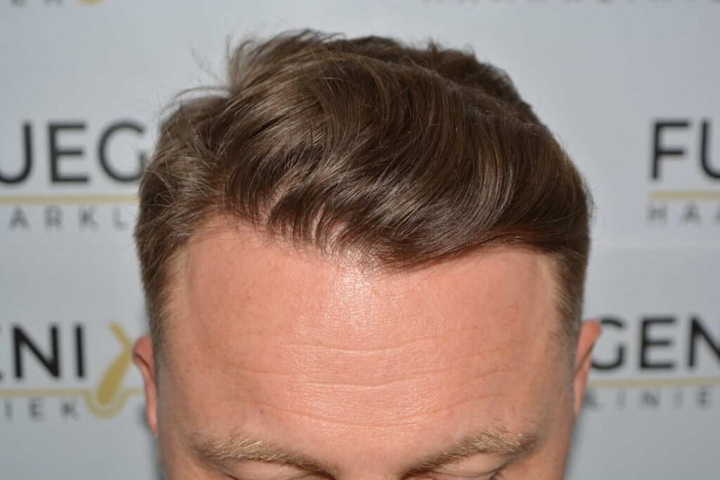 A Perfect Blond Hairline
