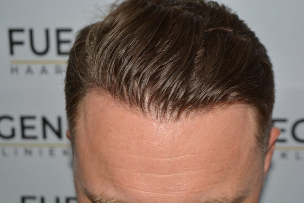 Hairline 18 Months Post Op Result