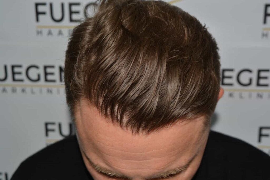 A Perfect Blond Hairline