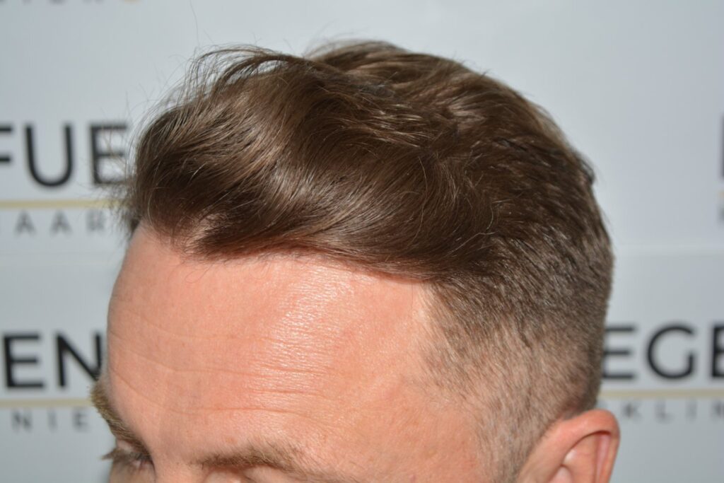 Hairline 18 Months Post Op Result