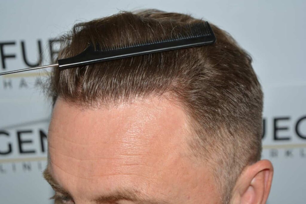 A Perfect Blond Hairline