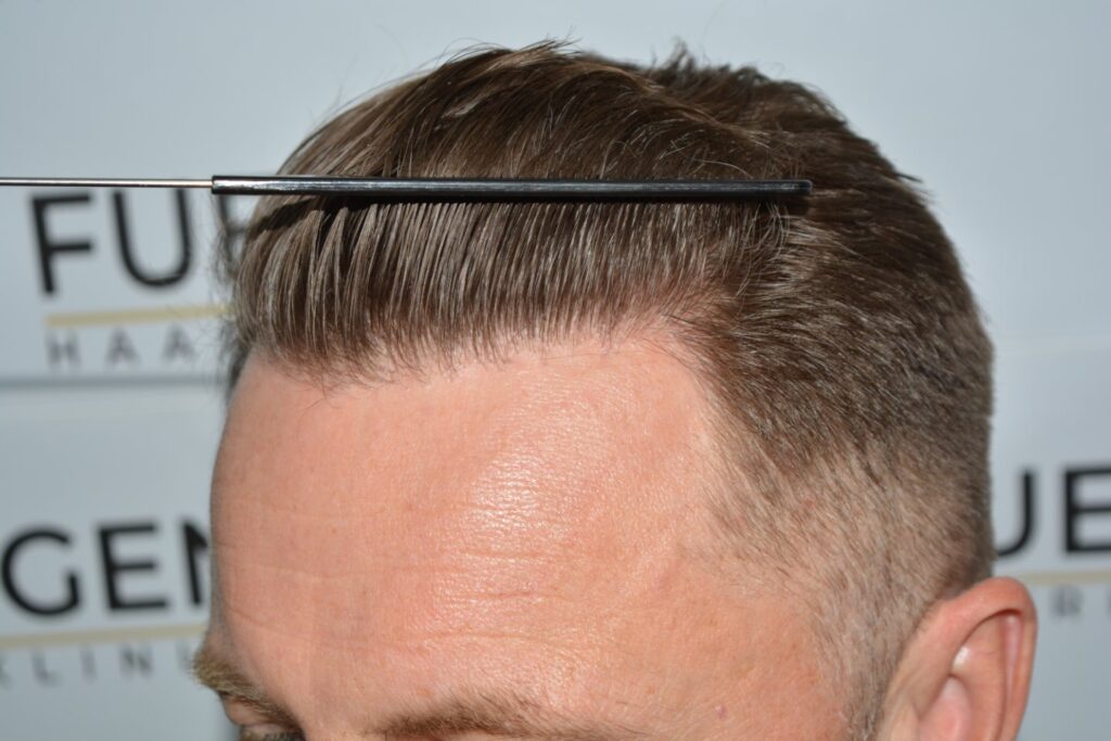 Hairline 18 Months Post Op Result