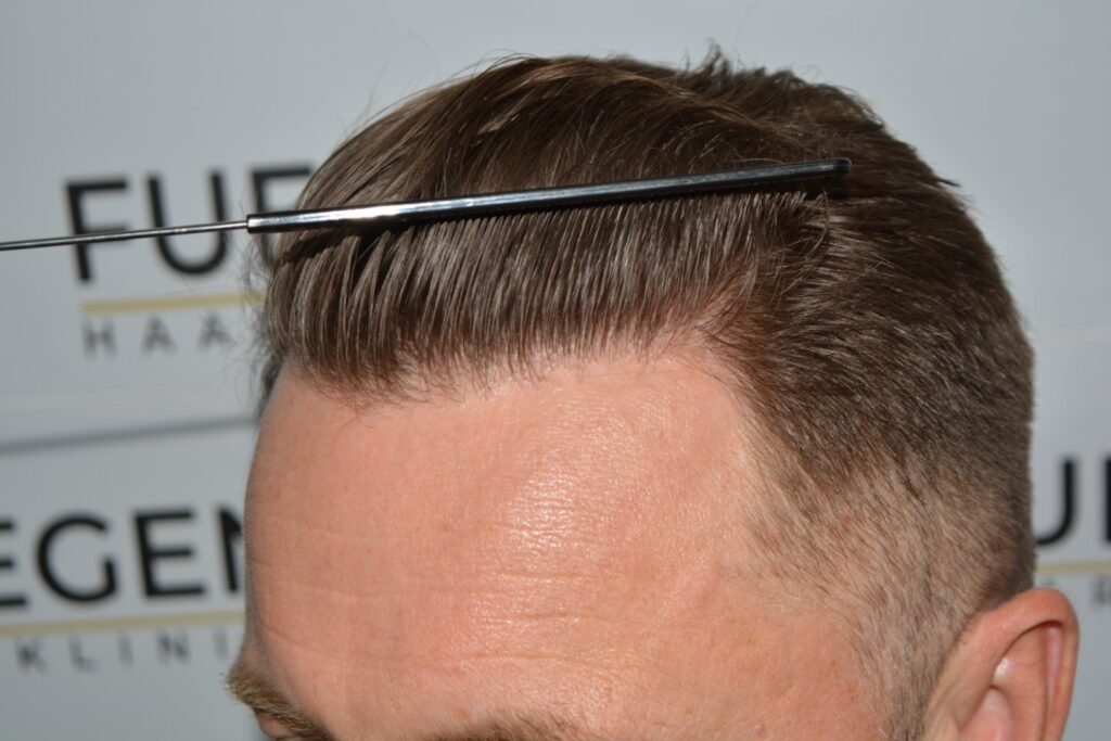 Hairline 18 Months Post Op Result